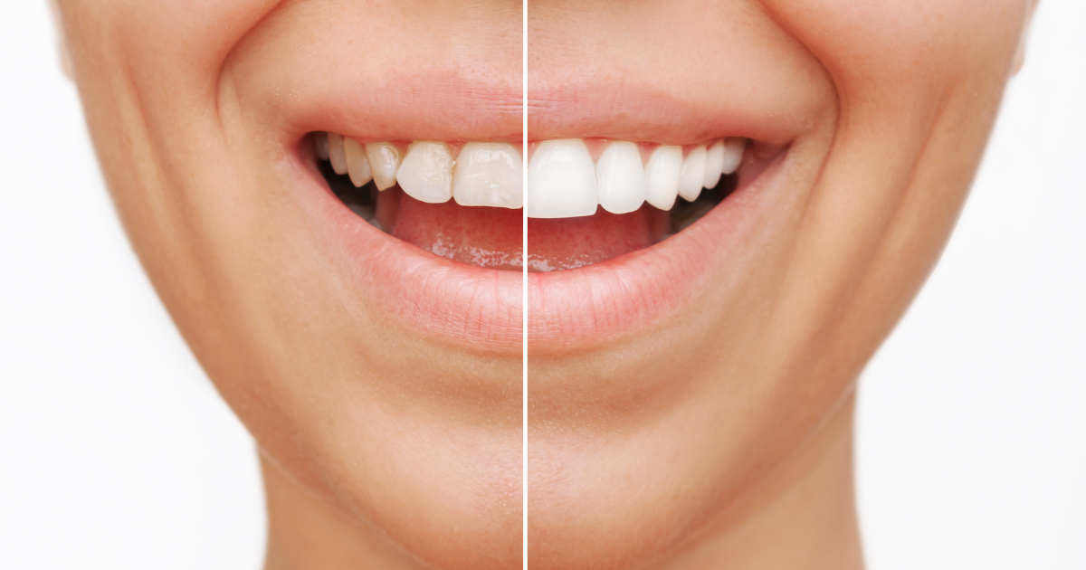 how to care for porcelain veneers