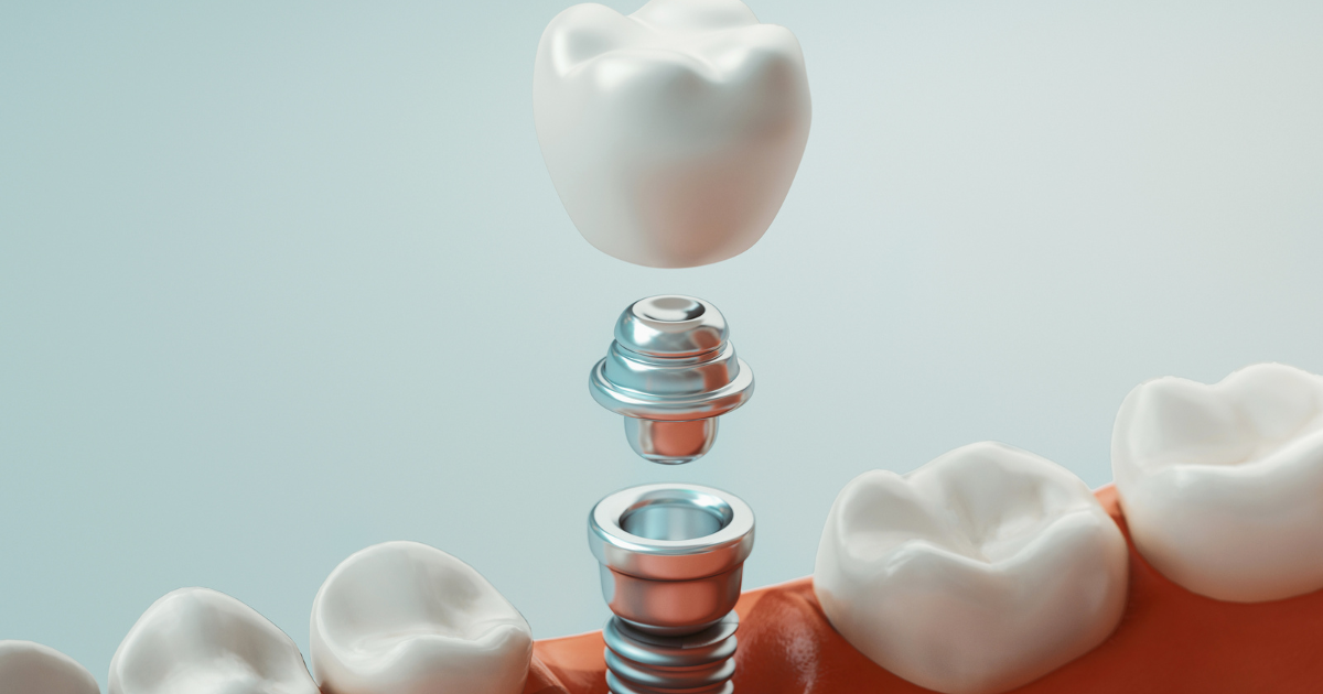 signs of dental implant failure